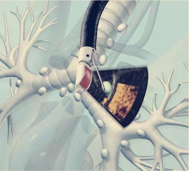 癌症晚期的妈妈抗癌5年,关于肺癌晚期的抗癌奇迹