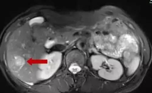 直肠癌病例分享,直肠癌肝转移做射频消融动画演示