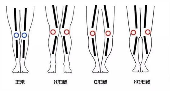 30天改善小腿外翻，告别括号腿，让你的腿像钢笔一样直