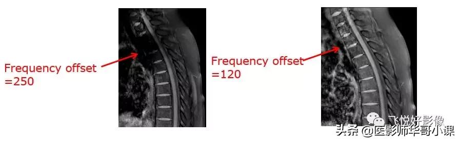 飞利浦磁共振独有技术,飞利浦磁共振减影技术