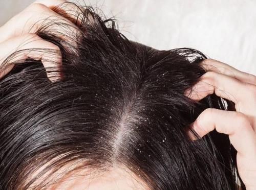 头皮很痒一抓一个白泥怎么回事,头皮瘙痒抠下白泥