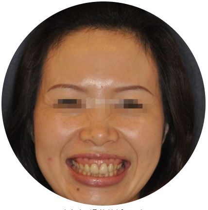 国家有关于牙齿的补贴吗,牙齿补贴报销政策