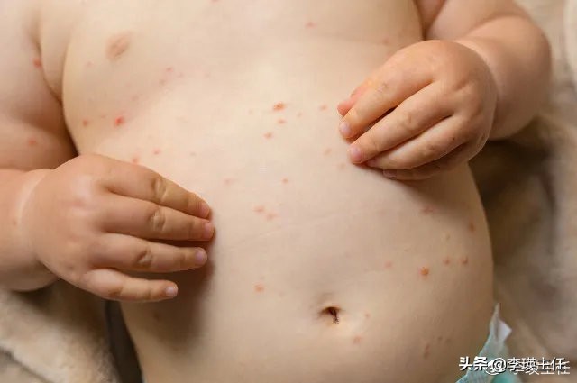 手足口病和水痘最明显的区别,手足口病和水痘怎么区分