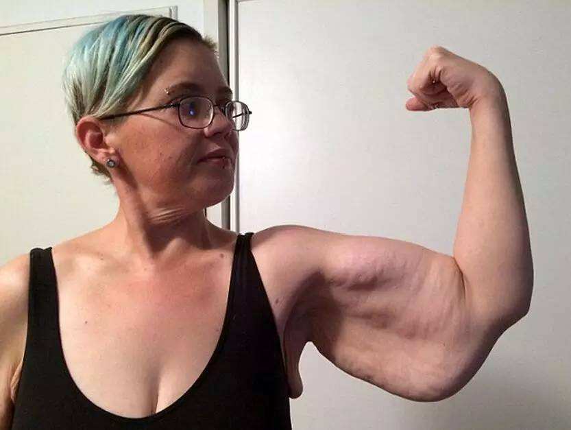 减肥后肚皮下垂松弛怎么办,减肥皮肤下垂松弛怎么办