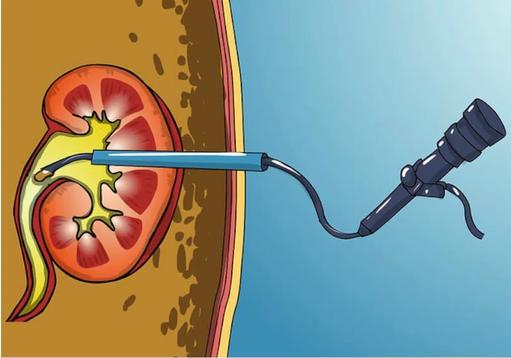 得了尿道结石怎么办,得了泌尿系统结石怎么办