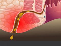 肛瘘要怎么检查才能确诊是肛瘘,什么是肛瘘肛瘘为何必须手术治疗