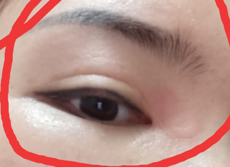 中医慢性荨麻疹自愈经验,慢性荨麻疹中医吃了还是痒