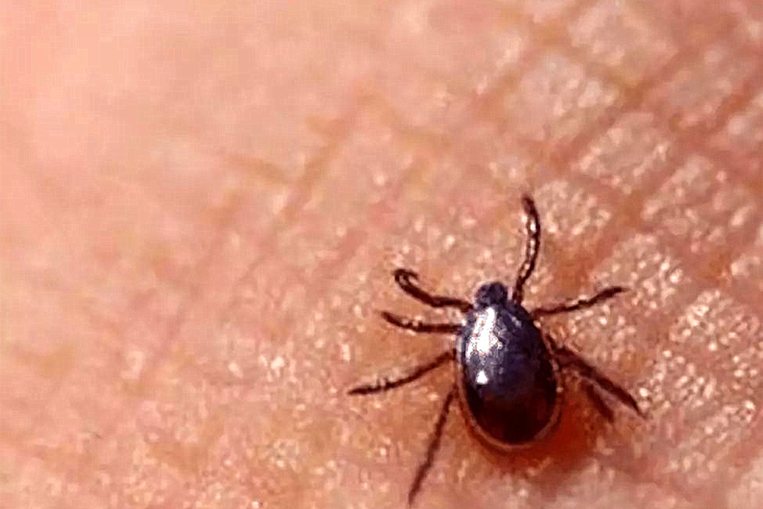 孩子被虫咬了发烧怎么办,小孩被恙虫咬会死吗