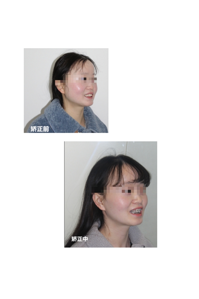 南京牙齿矫正内倾,南京牙齿矫正比较好的医院有哪些