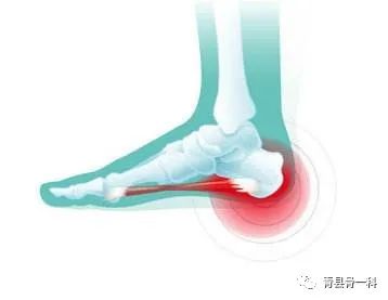 足跟骨痛是什么原因怎样治,脚跟骨痛是怎么治疗