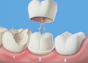 花2万美牙被骗，她一口好牙被打磨剩三分之一，变“怪物”？