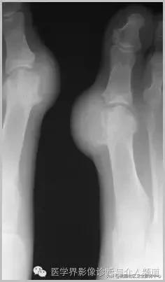 软组织钙化是不是骨化性肌炎,软组织钙化或骨化