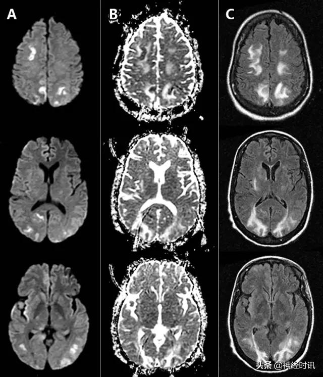 脑卒中的快速识别ppt,脑卒中神经影像学实例解析