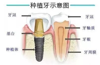 为什么做了烤瓷牙的人都后悔,烤瓷牙套弄上后悔了该怎么办
