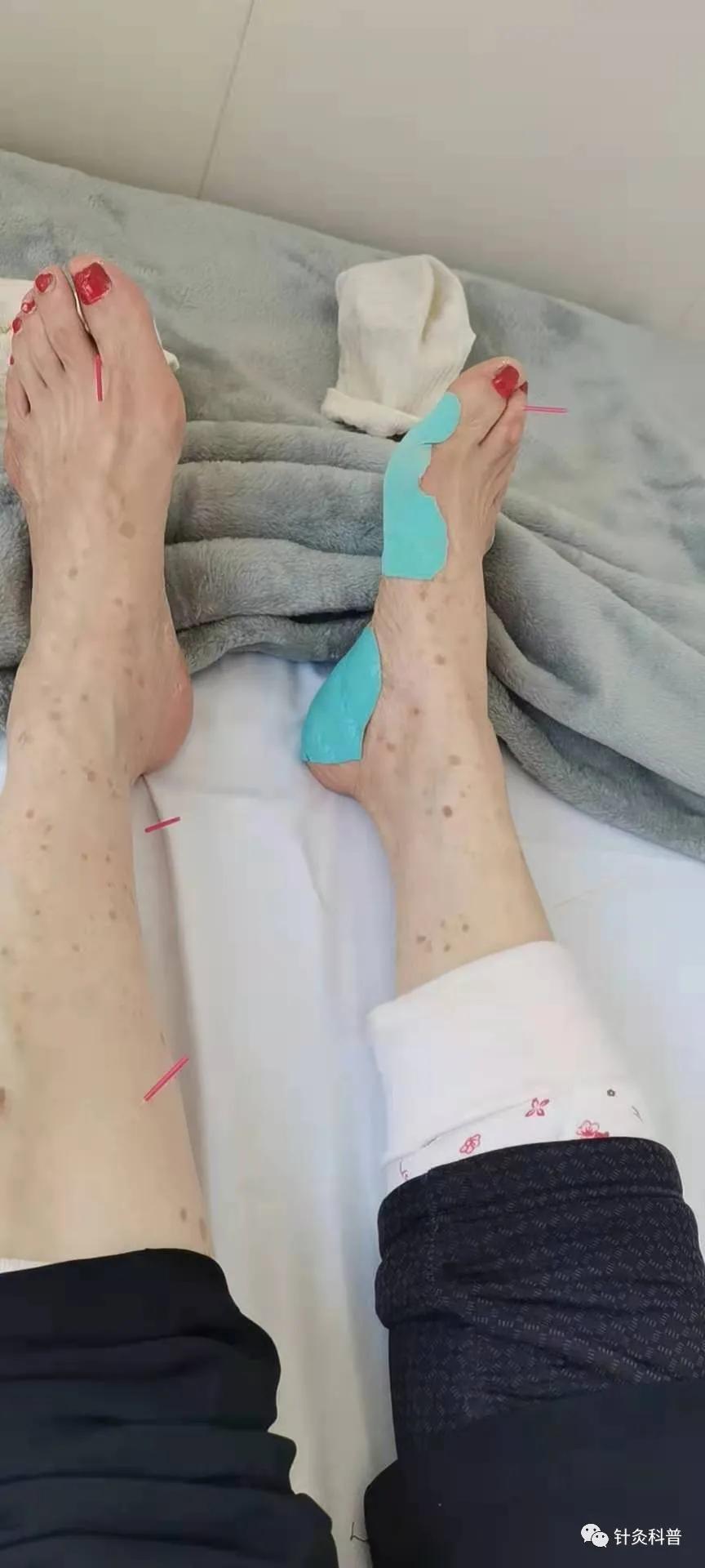 针灸治疗手不会握,针灸也不能调理手麻怎么办