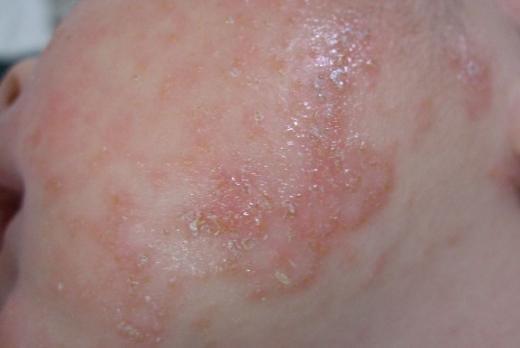 湿疹老不好到底看中医还是看西医,湿疹不一定是坏事吗