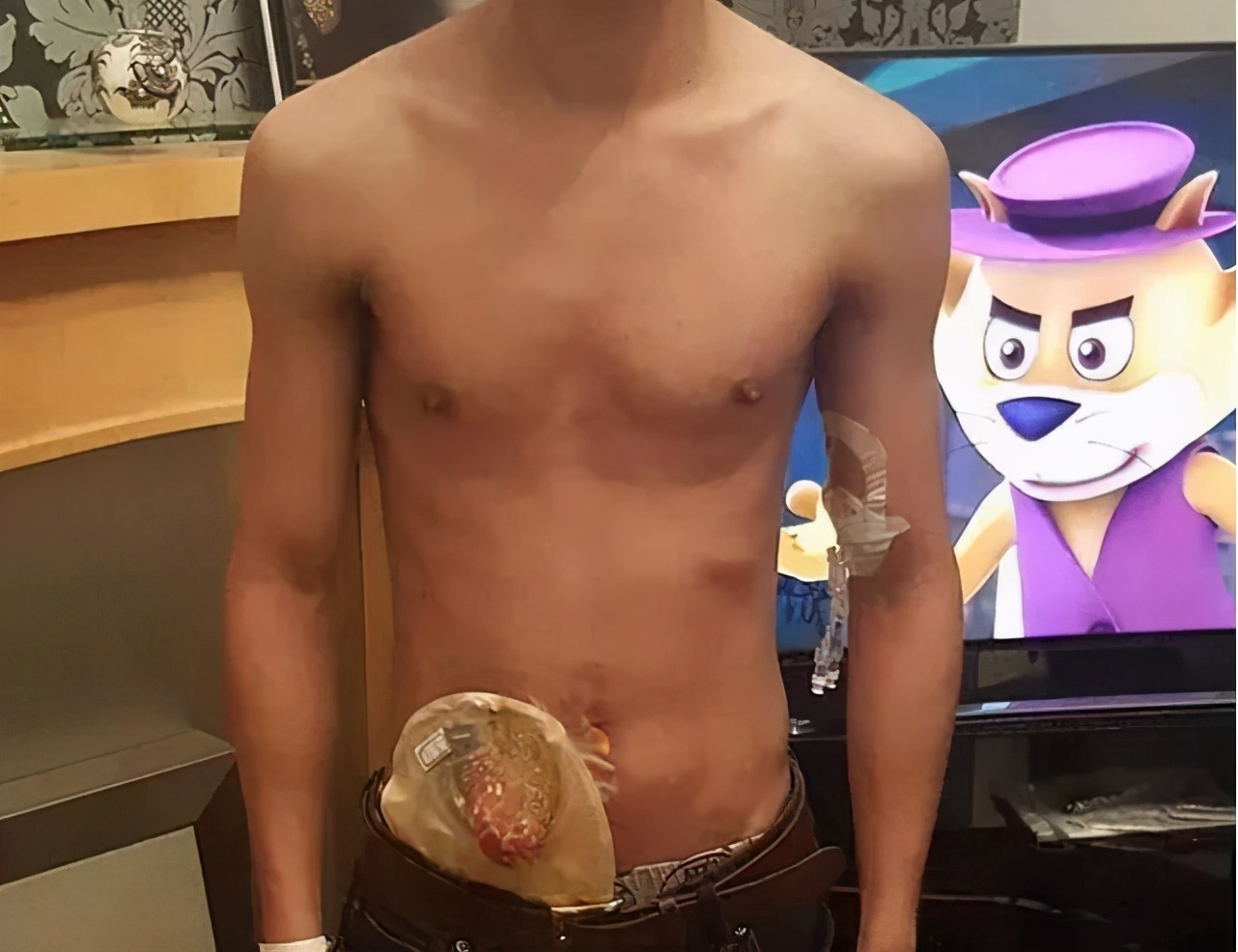 艾滋病肛周感染,肛周感染艾滋病