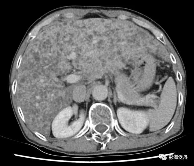 肝脏弥漫性病变严重吗,肝脏弥漫性的病变的症状