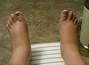 舌头肥大有齿痕快速解决方法,舌头肥大有齿痕是怎么回事