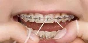 超详细的初戴正畸牙套的注意事项,戴全瓷牙套后需要注意什么