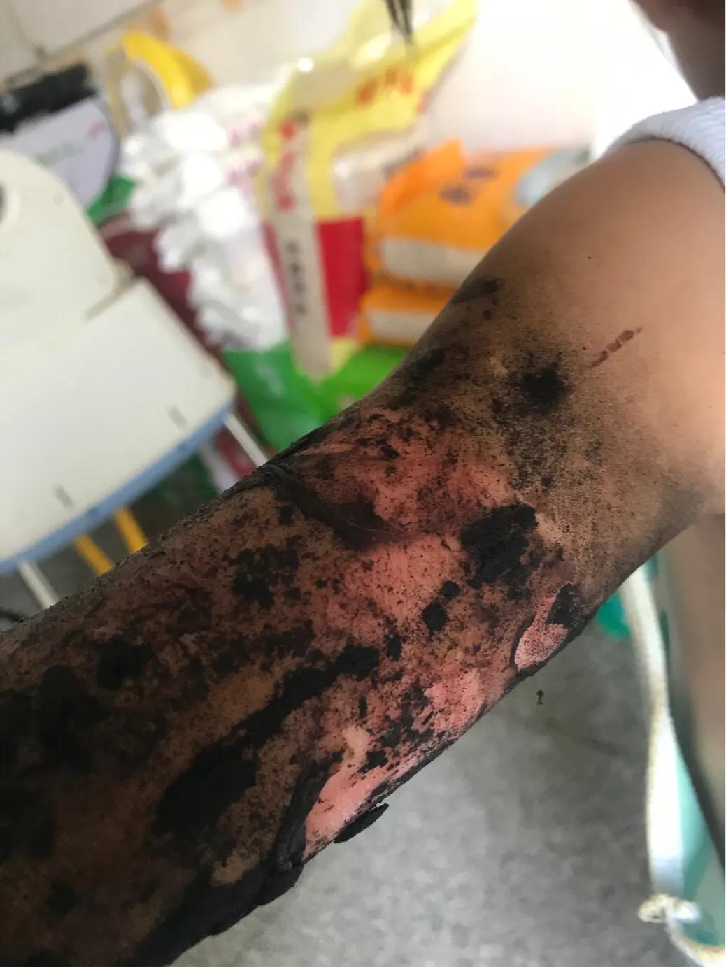 孩子大面积烫伤治疗流程,记录女儿被烫伤到治疗全过程