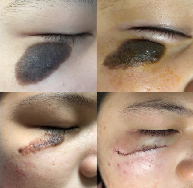 黑色素痣用激光还是手术,痣是手术切除好还是激光好