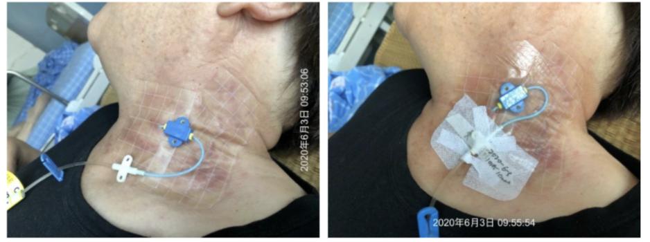 又见接触性皮炎？！不妨试试地塞米松+水胶体