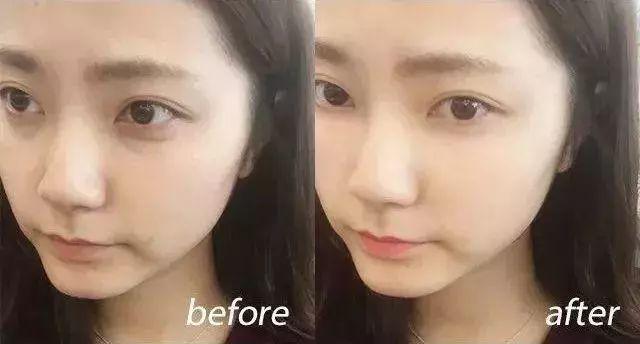 玻尿酸蒸汽热敷眼罩有用吗,热敷眼罩可以加速玻尿酸代谢吗