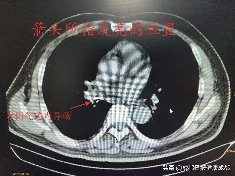 吃面出意外排骨掉进气管