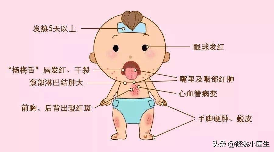 少儿川崎病,川崎病是什么样子的儿童