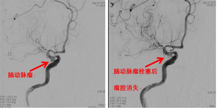 介入不放支架可以吗,介入放支架治标不治本