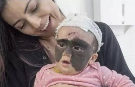 女童顶着“蝙蝠”形胎记出生，历经7次手术，如今过得怎样了