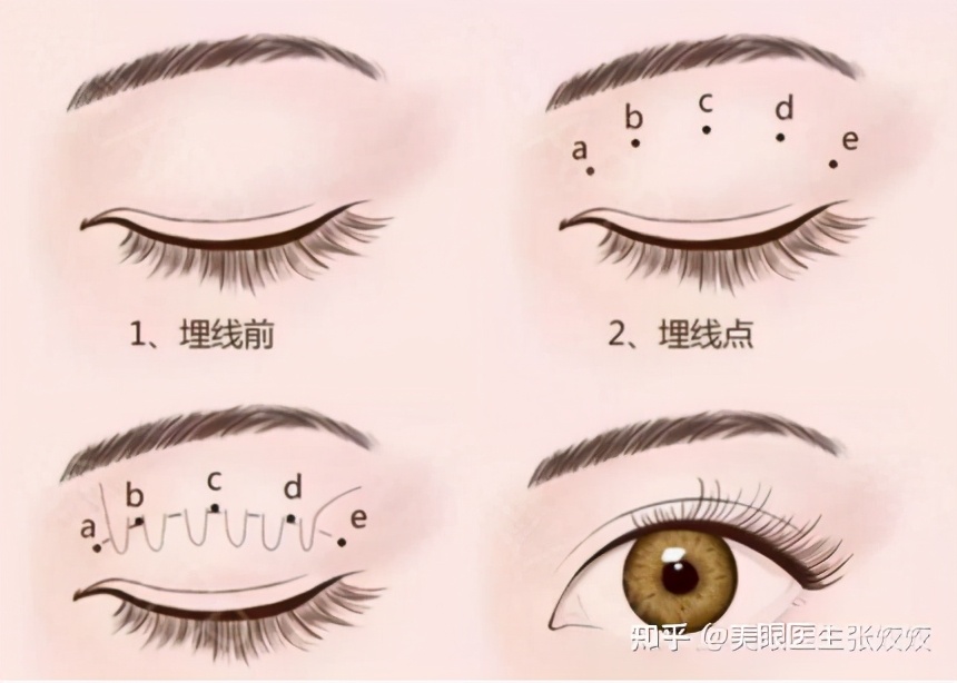 内双的人割双眼皮会更自然吗,怎么把内双变双眼皮的自然方法