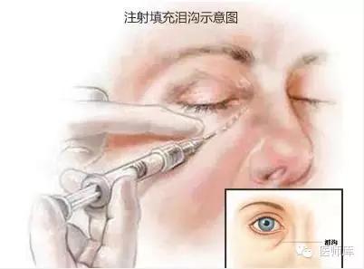 北大整形教授张宗学,全国有名的眼袋整形专家