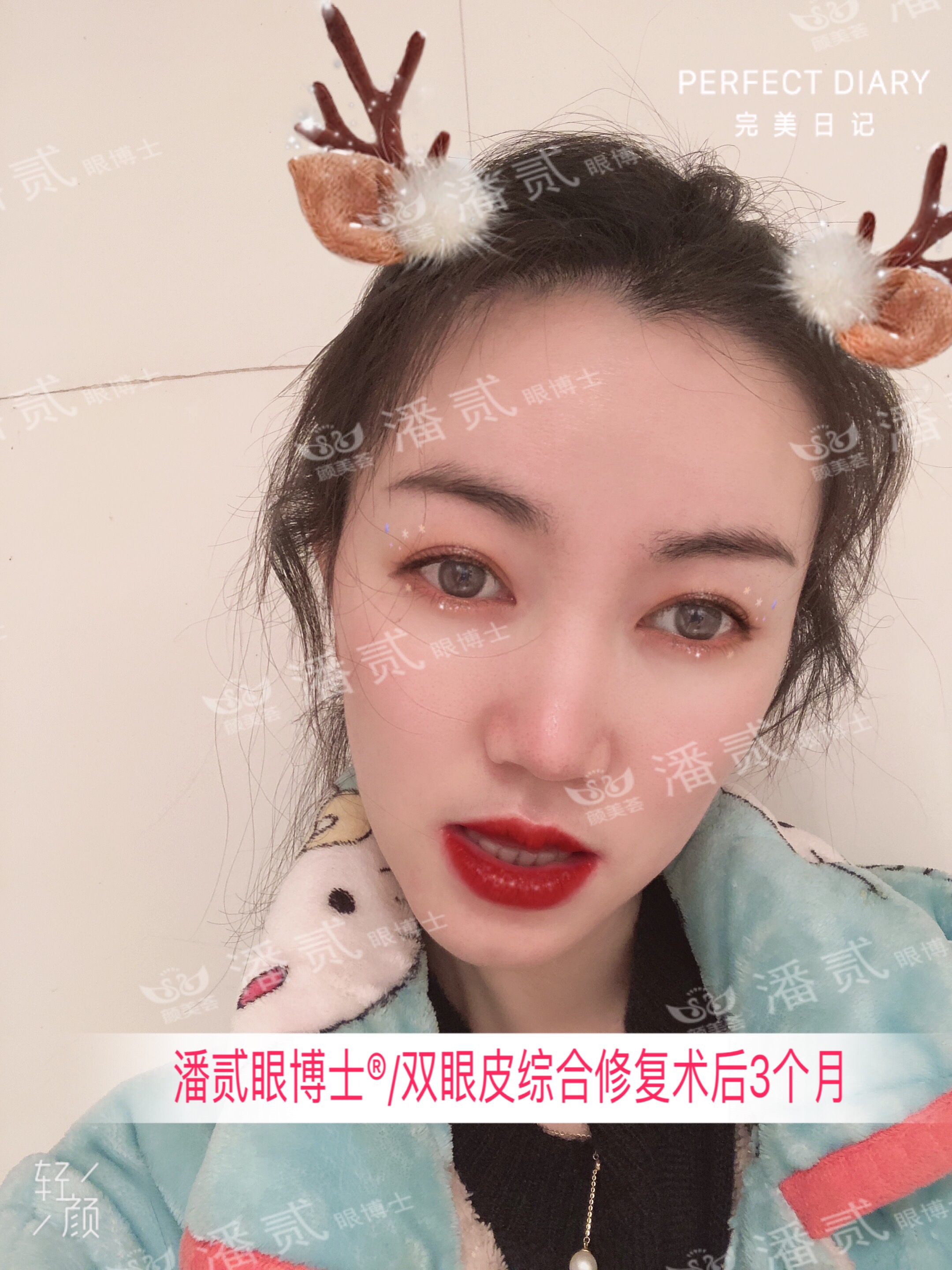 广州双眼皮修复内双,广州双眼皮修复可以只修眼尾吗