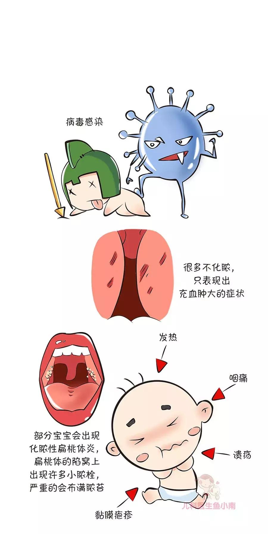 扁桃体切了喉咙还是老是发炎,扁桃体经常发炎该不该切