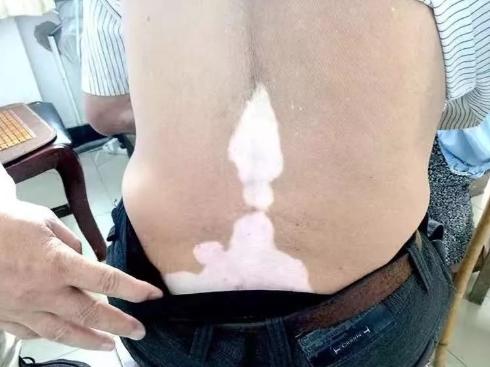 不看不知道，原来你患的是神经节段型白癜风