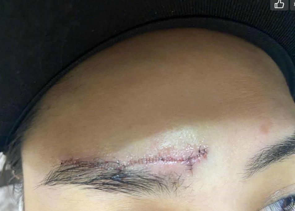 医美专家爆阿娇6㎝伤口肯定留疤痕,激光也难以恢复平滑肌肤