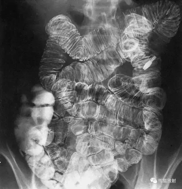 「收藏」11种消化道造影解剖图谱