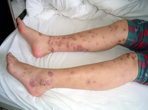 口腔溃疡老发作需警惕自身免疫病,口腔溃疡反复发作要警惕什么癌