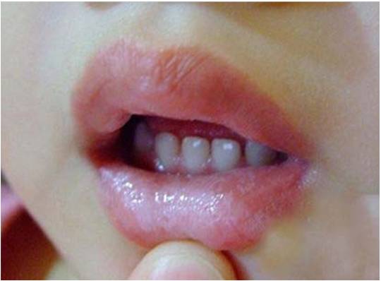 一个月宝宝口腔上颚白色的是什么,婴儿口腔上颚有一个小米样的白点