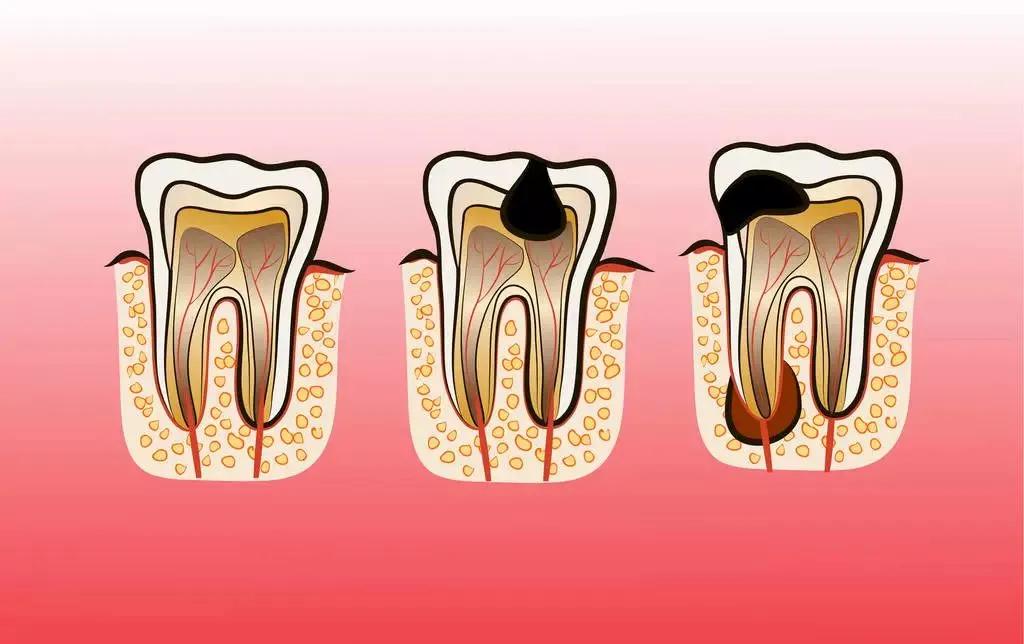 老年人牙疼最快止疼法,老年人牙疼是怎么回事