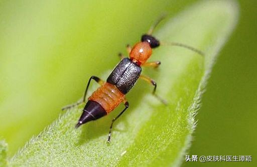 怎么知道隐翅虫皮炎严不严重,怎样能治疗隐翅虫皮炎