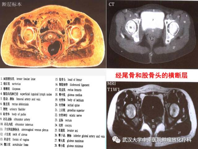 女性盆腔解剖与断层影像