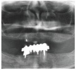 满口缺牙如何补牙,满口缺牙怎么办