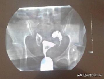 青岛助孕专家于萍：输卵管积水怎么办？还能怀孕吗？