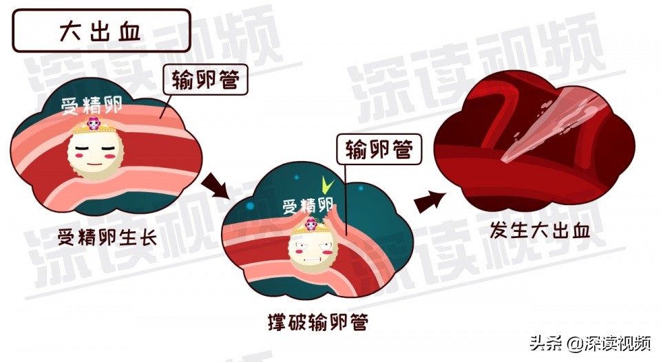 关爱女性|3.8妇女节深读特别节目——《宫外孕专题》