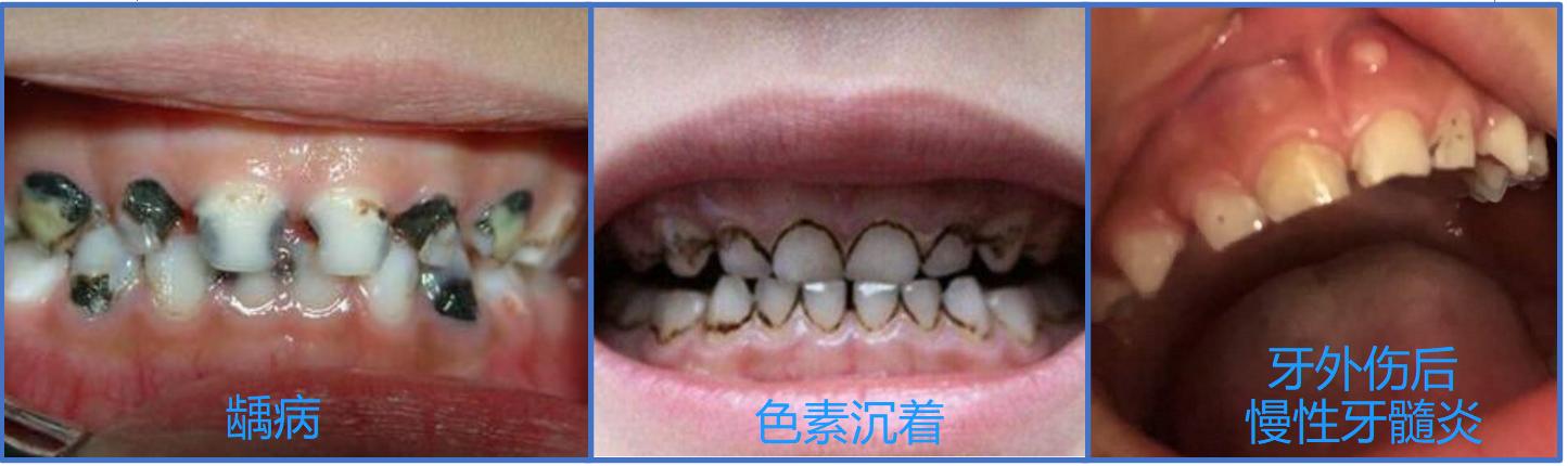 宝宝门牙发黑怎么根管治疗,宝宝门牙变黑是什么原因