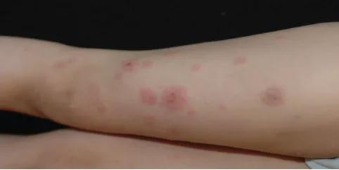 孩子身上起红色硬点点痒是水痘吗,宝宝身上起红疙瘩痒是水痘吗