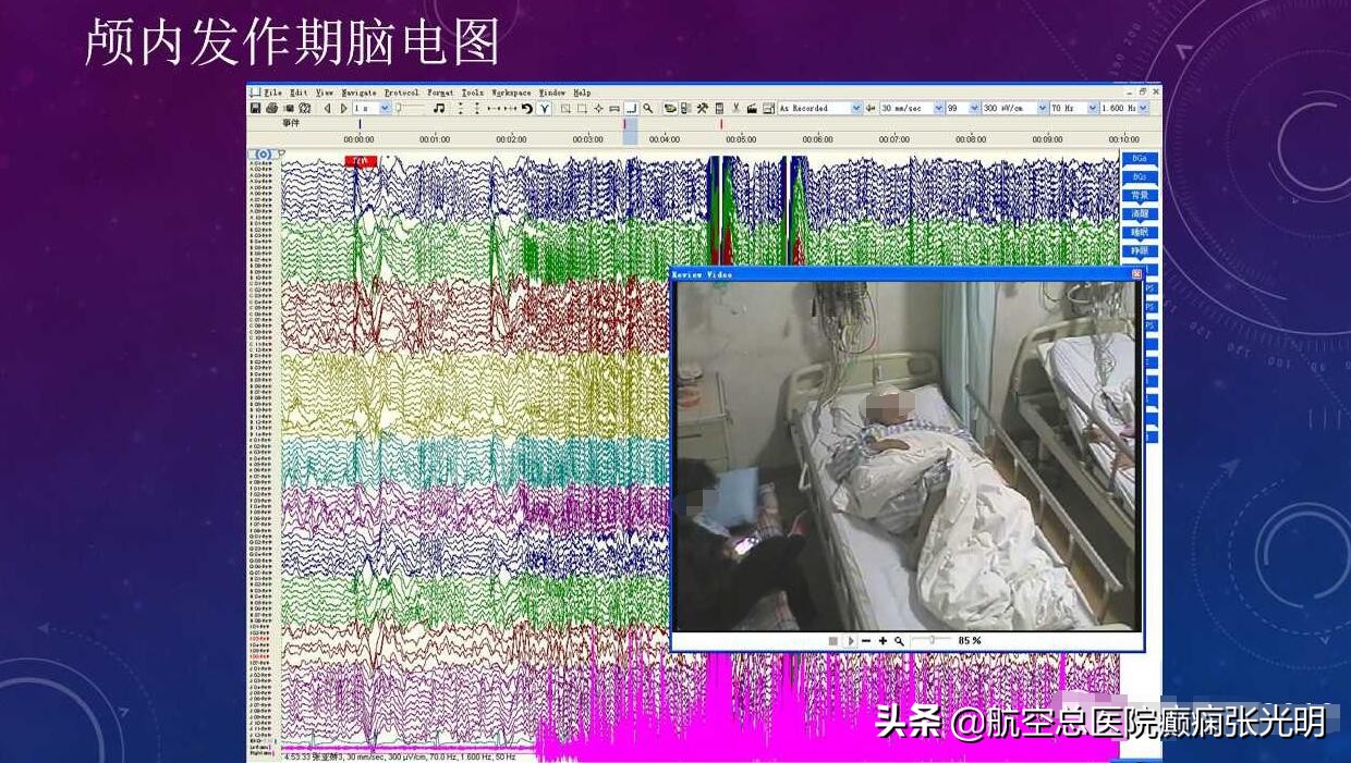 张光明左颞叶癫痫手术成功率,张光明谈治疗癫痫的方法有哪些